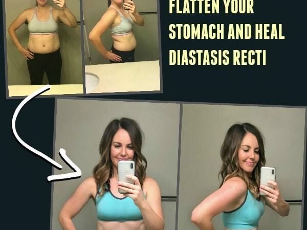 Diastasis Recti Plan