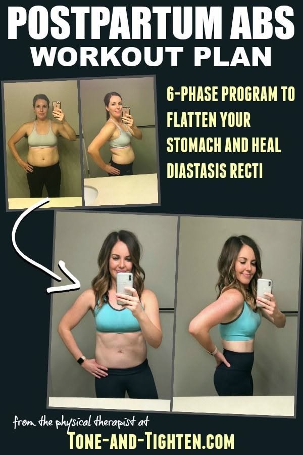 Diastasis Recti Plan